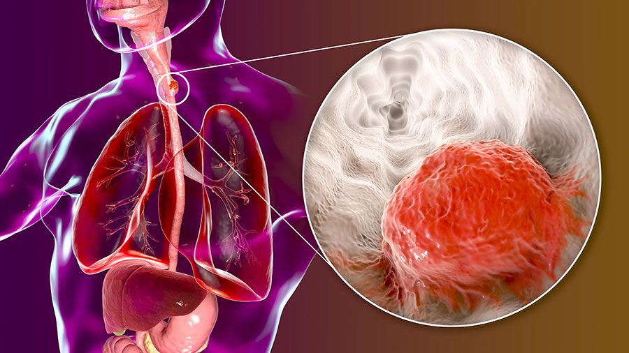 Esophageal Cancer Symptoms